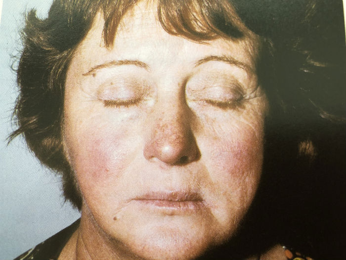 Rosacea - Rosácea: O Que é, Quais os Sintomas e o Tratamento