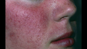 rosacea blog2