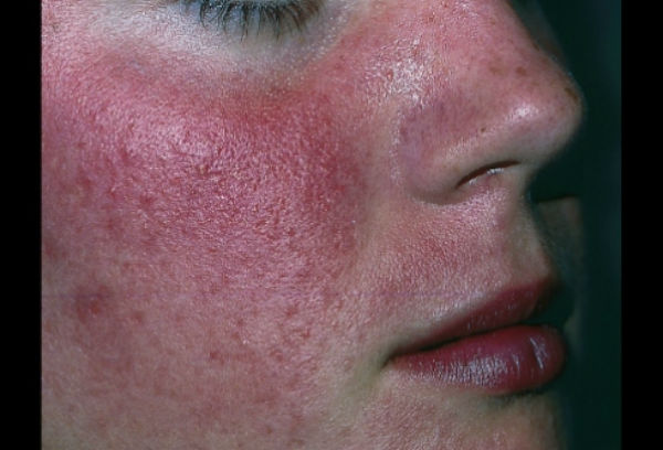 rosacea blog2 - Rosácea: O Que é, Quais os Sintomas e o Tratamento