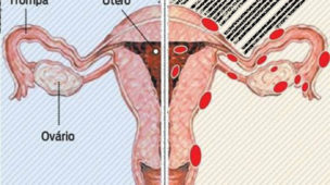 O Que É Endometriose Quais seus Sintomas Fatores de Risco e Tratamento