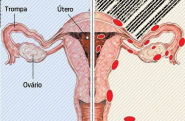 O Que É Endometriose, Quais Seus Sintomas e o Tratamento