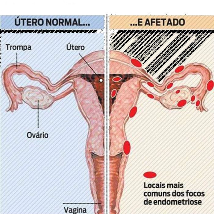 O Que E Endometriose Quais seus Sintomas Fatores de Risco e Tratamento - O Que É Endometriose, Quais Seus Sintomas e o Tratamento