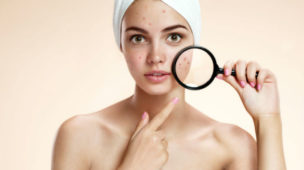 Características da pele oleosa - Acne