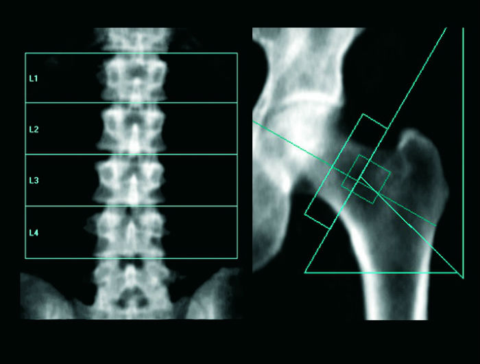 Densitometria ossea - O Que É Osteoporose, Quais Seus Sinais e Fatores de Risco