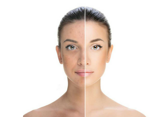 Diagnostico Melasma - O Que É Melasma, Qual O Melhor Tratamento e a Melhor Prevenção