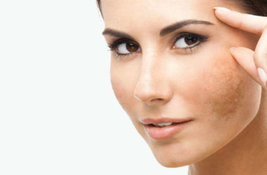 O Que É Melasma, Qual O Melhor Tratamento e a Melhor Prevenção