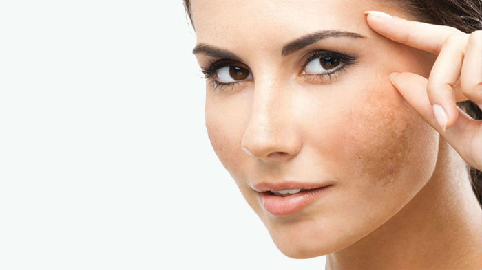 o que e o melasma - O Que É Melasma, Qual O Melhor Tratamento e a Melhor Prevenção