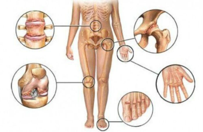 o que e osteoporose - O Que É Osteoporose, Quais Seus Sinais e Fatores de Risco