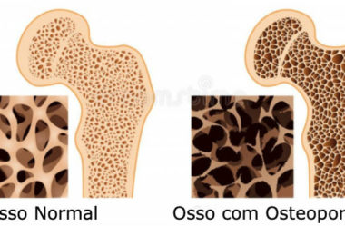 O Que É Osteoporose, Quais Seus Sinais e Fatores de Risco