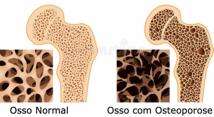 osso com osteoporose Blog - O Que É Osteoporose, Quais Seus Sinais e Fatores de Risco