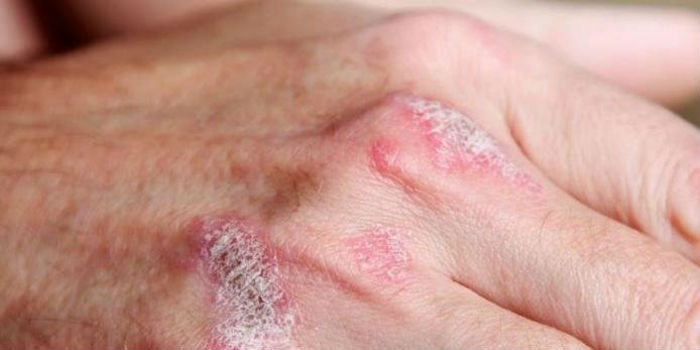 psoriase maos - O Que É Psoríase, Quais os Sintomas e o Tratamento