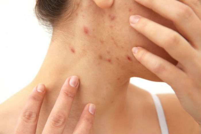 Prevencao Acne - Acne Vulgar: O Que É, Causas, Sintomas e Tratamento