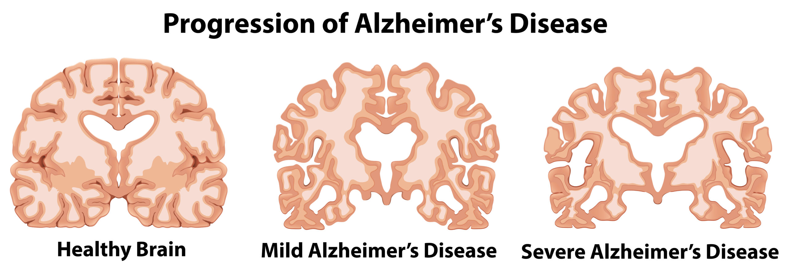 13954 scaled - O que é Alzheimer e quais seus principais sintomas